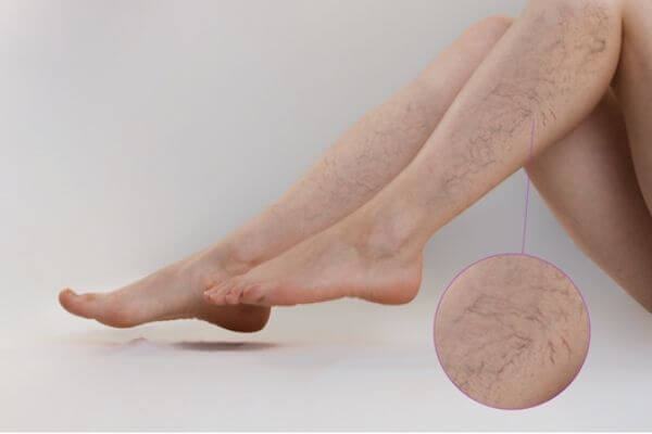 Giãn tĩnh mạch và những điều chị em cần biết để bảo vệ đôi chân 35 giãn tĩnh mạch