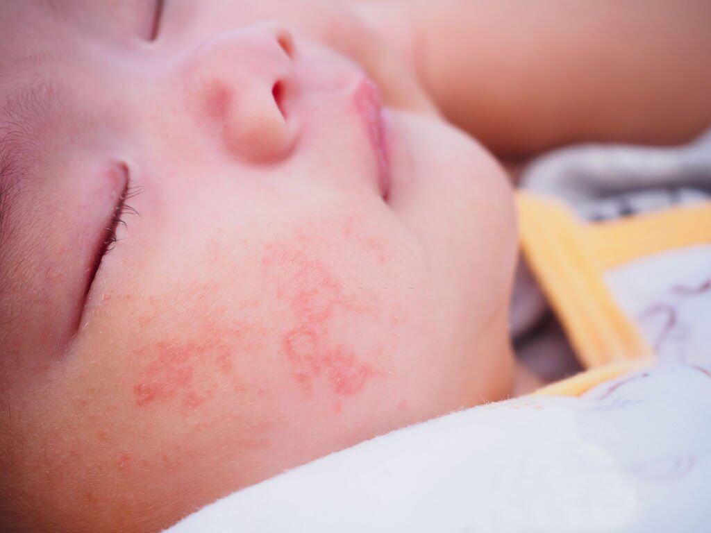 trẻ bị sưng mắt trẻ bị sưng mắt