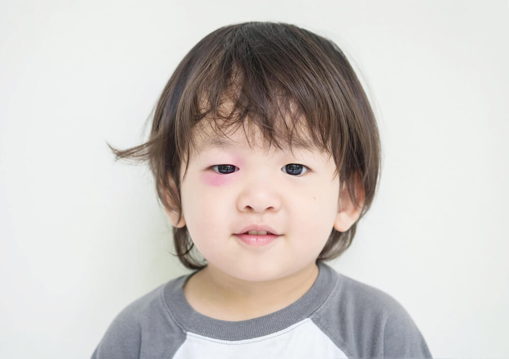 trẻ bị sưng mắt