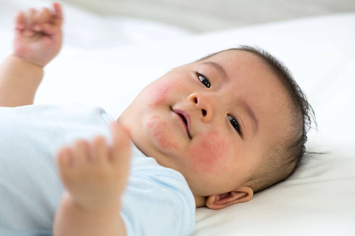 các bệnh thường gặp vào mùa hè các bệnh thường gặp vào mùa hè
