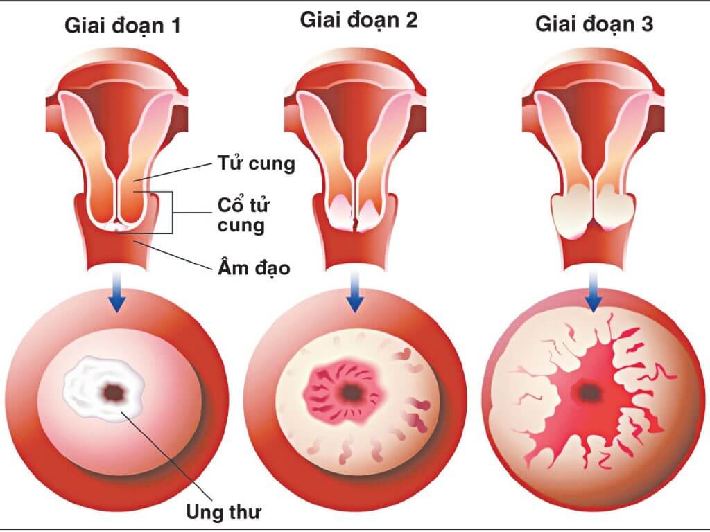 viêm lộ tuyến tử cung