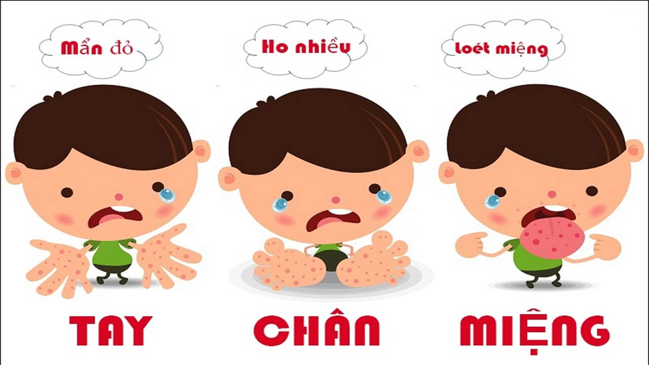 Nhận biết bệnh tay chân miệng ở trẻ em Nhận biết bệnh tay chân miệng ở trẻ em