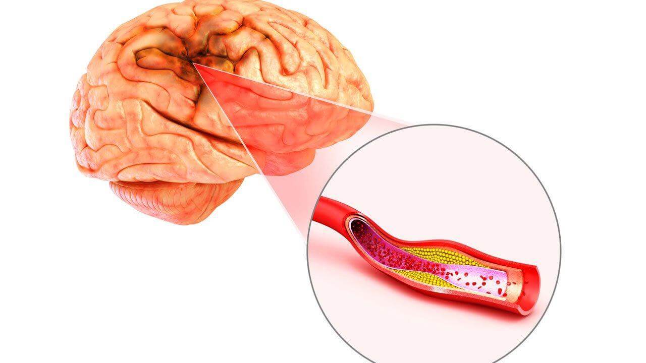Ảnh hưởng của chứng hay quên ở người trẻ 