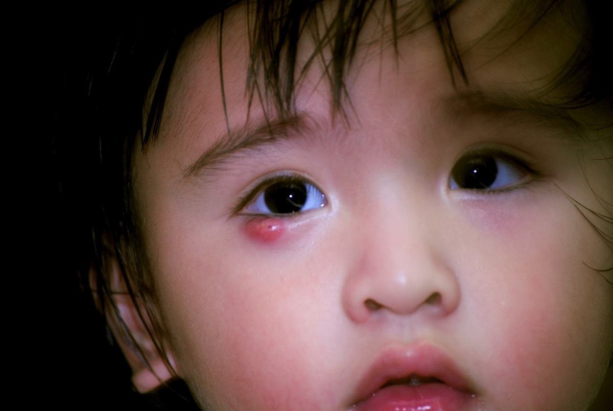 lẹo mắt