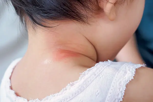 trẻ bị hăm cổ