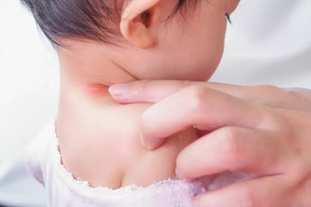trẻ bị hăm cổ trẻ bị hăm cổ