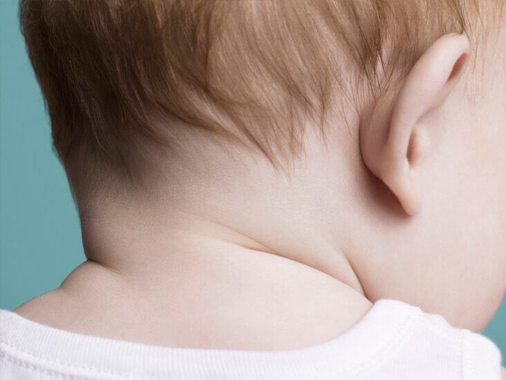 Cách nhận biết trẻ bị hăm cổ Cách nhận biết trẻ bị hăm cổ