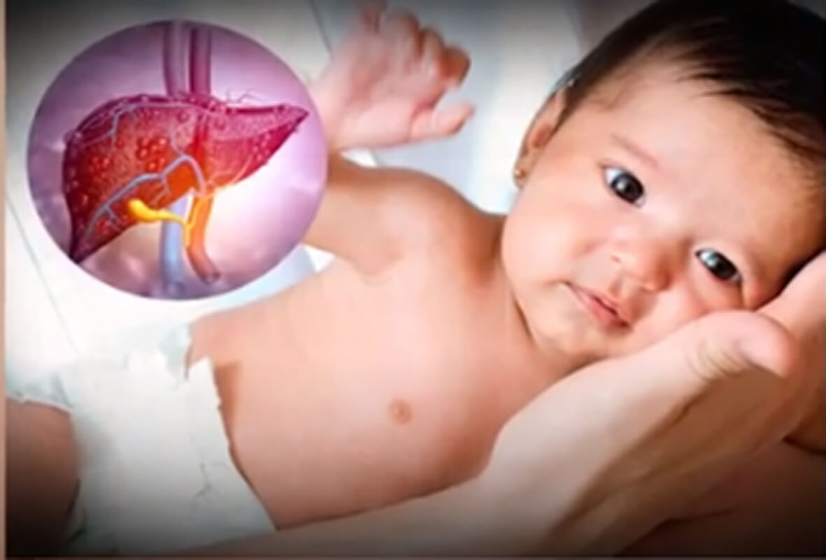 Viêm gan bí ẩn ở trẻ viêm gan bí ẩn ở trẻ