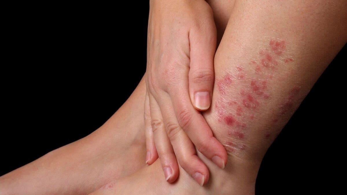 Nguyên nhân bị nấm da Nguyên nhân bị nấm da