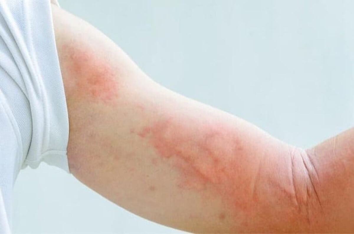 Nổi mề đay sau sinh Nổi mề đay sau sinh