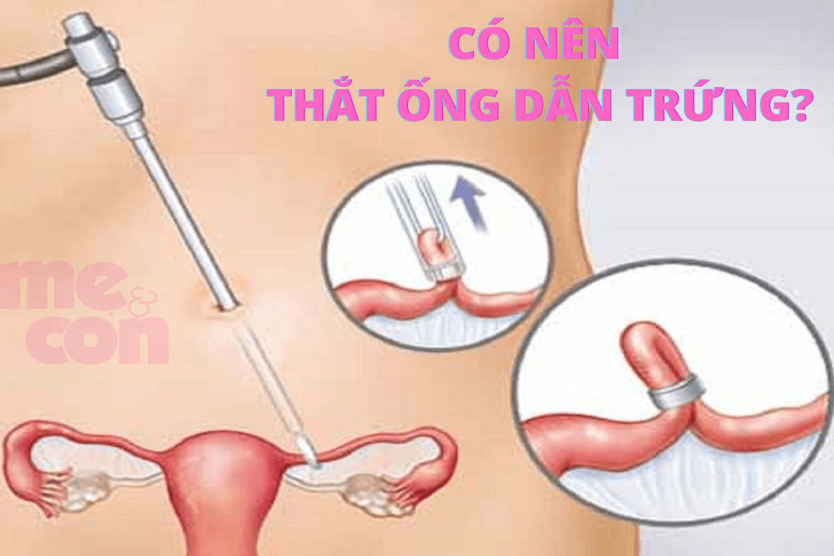 có nên thắt ống dẫn trứng
