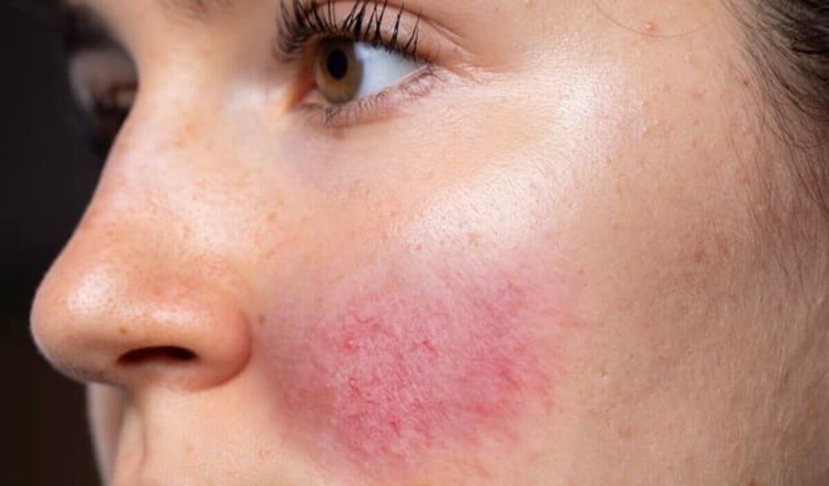 da mặt bị dị ứng ngứa phải làm sao da mặt bị dị ứng ngứa phải làm sao