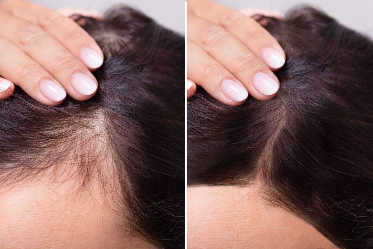 cách trị hói đầu ở nữ