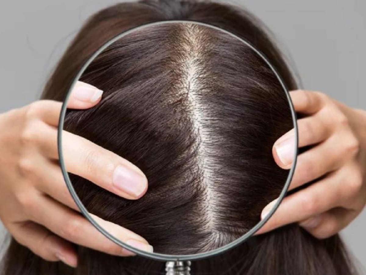 cách trị hói đầu ở nữ cách trị hói đầu ở nữ