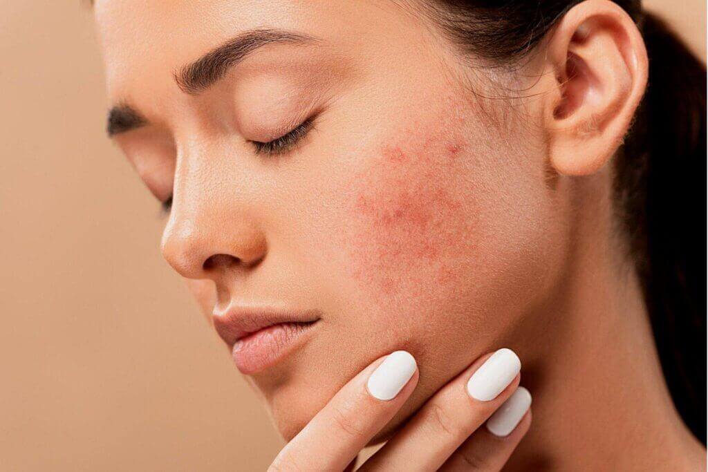 cách trị mụn ẩn dưới da