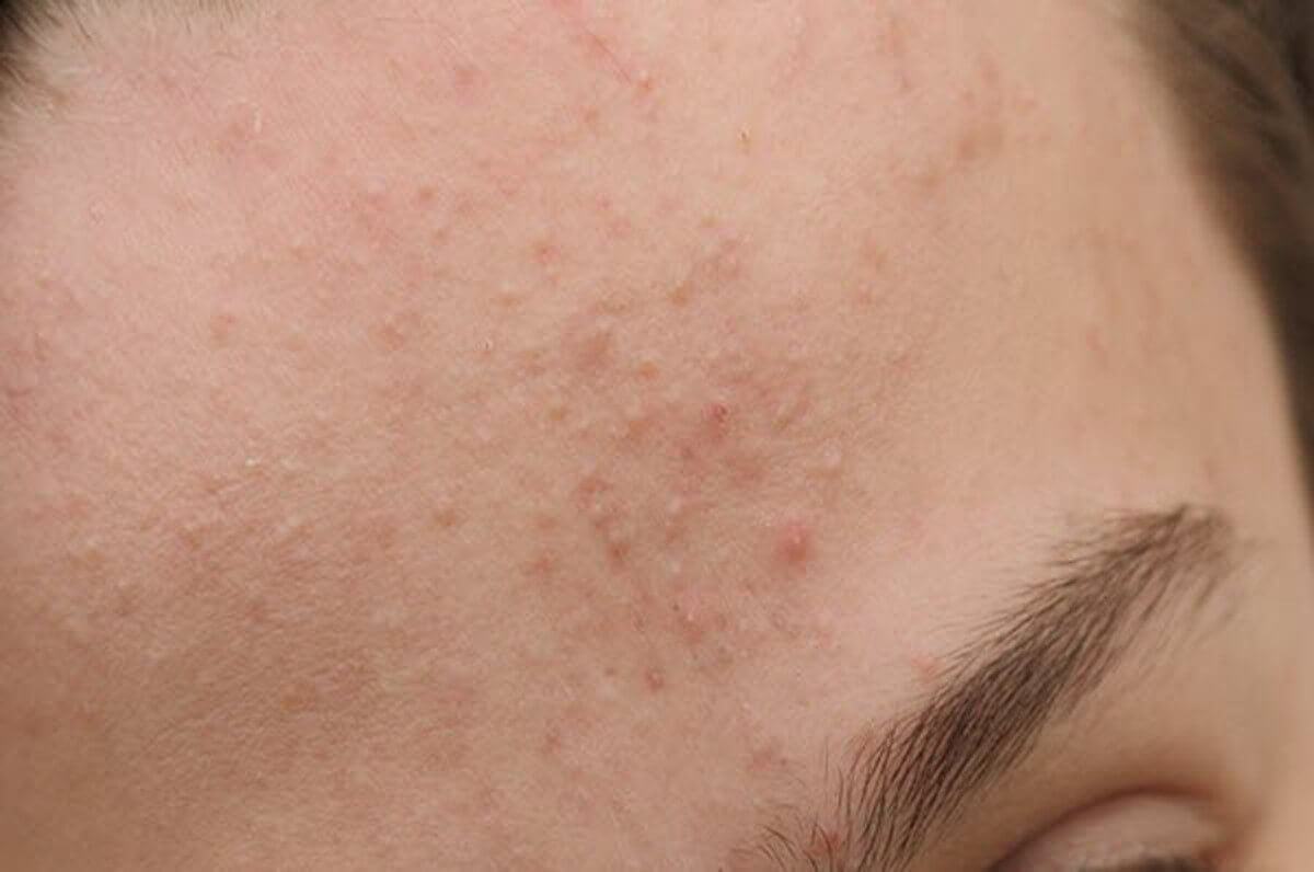mụn ẩn xuất hiện ở đâu mụn ẩn xuất hiện ở đâu