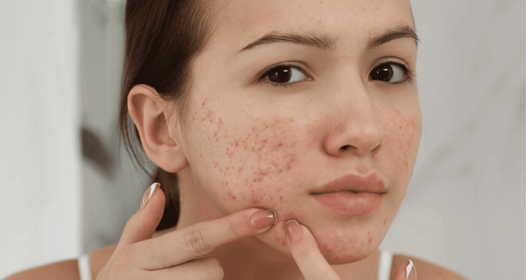 tình trạng mụn sưng viêm