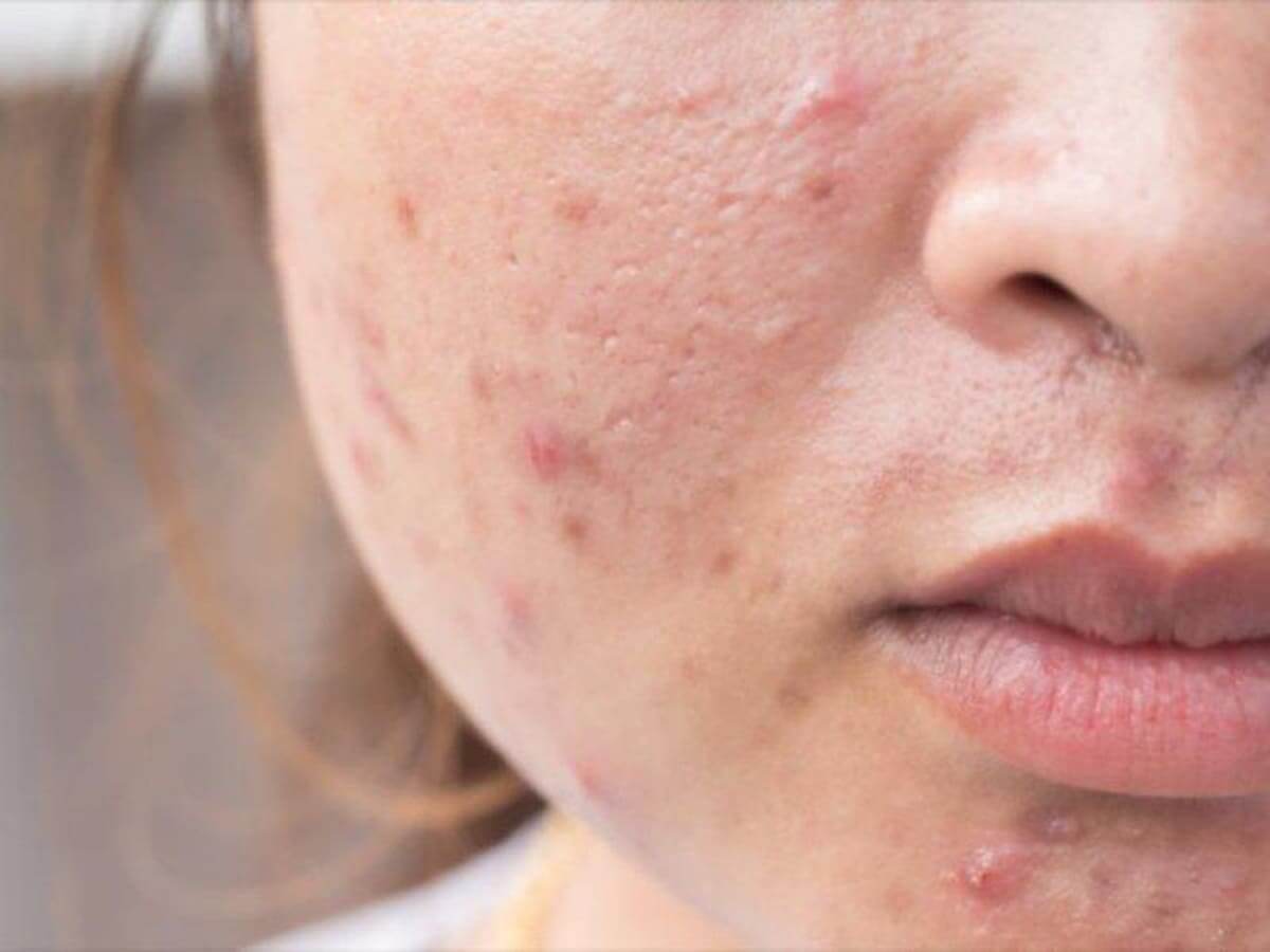 mụn viêm đỏ là gì mụn viêm đỏ là gì