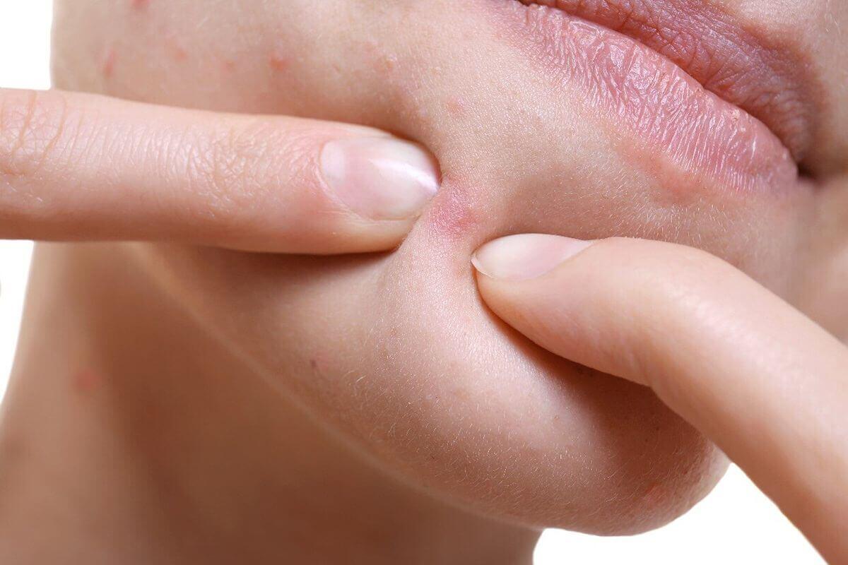 có nên tự nặn mụn không có nên tự nặn mụn không
