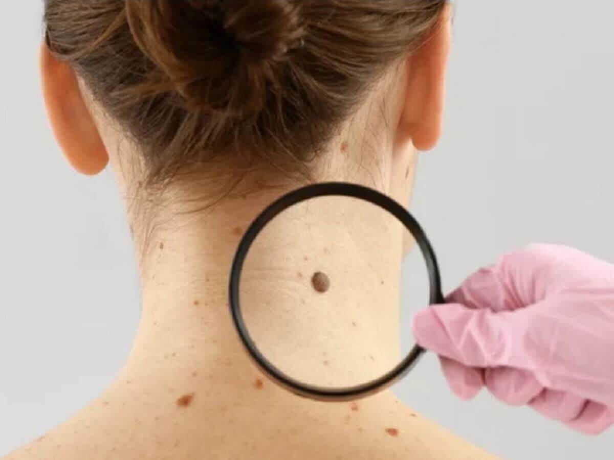 có nên tẩy nốt ruồi không