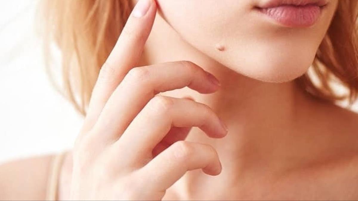 có nên tẩy nốt ruồi gần miệng không