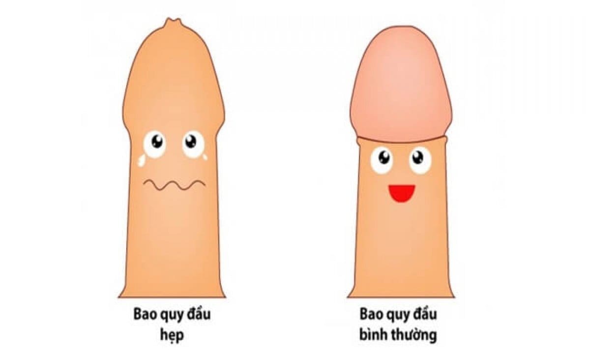hẹp bao quy đầu ở trẻ