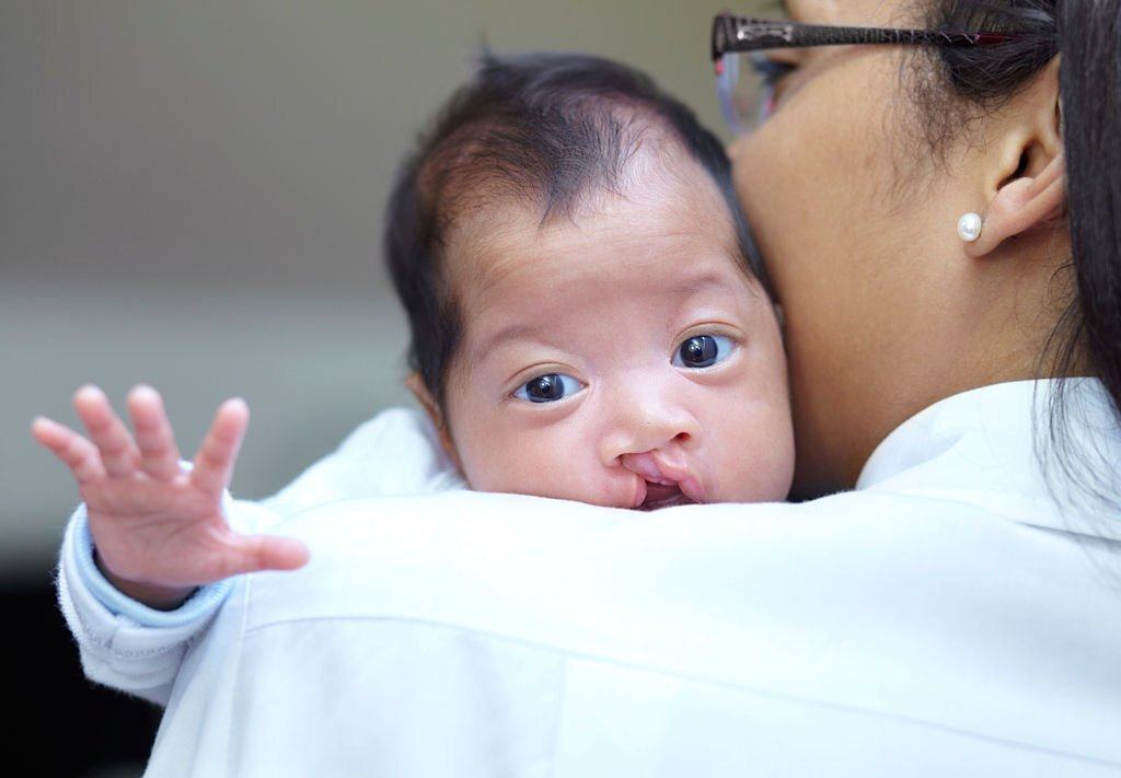 Sứt môi hở hàm ếch sứt môi hở hàm ếch