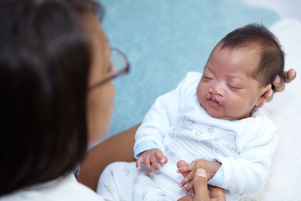 sứt môi hở hàm ếch điều trị như thế nào