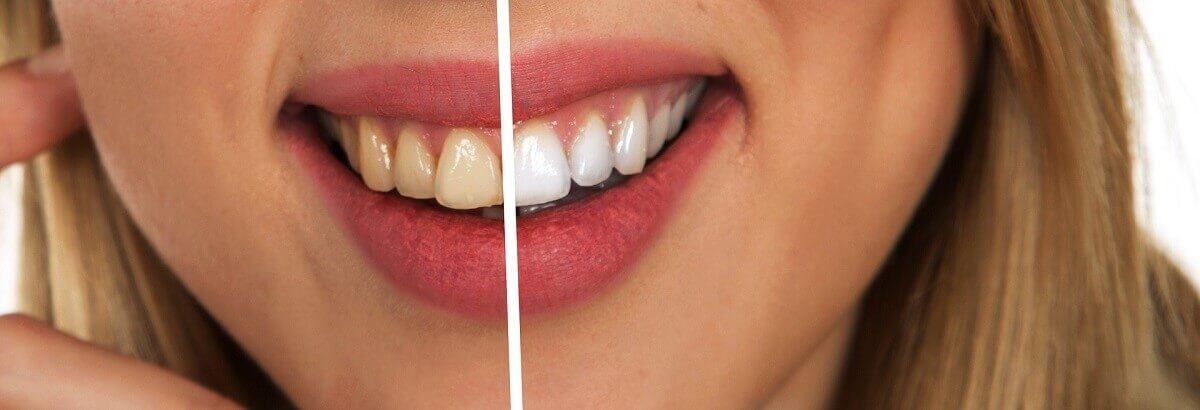 răng bị vàng răng bị vàng
