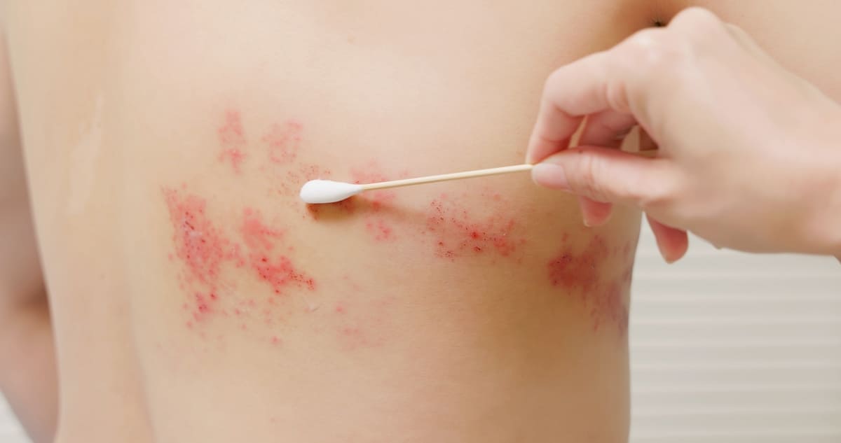 Cách chữa bệnh zona thần kinh