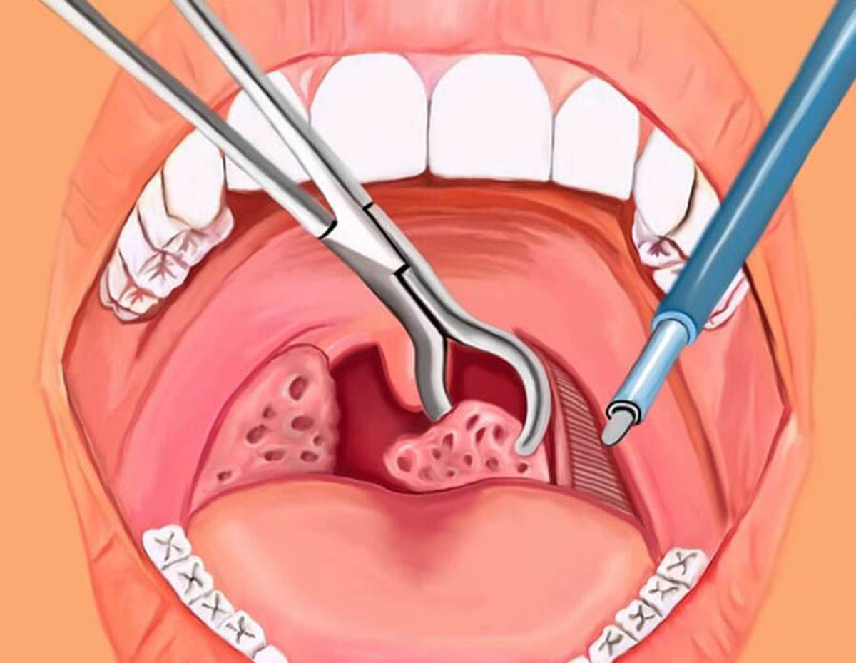 Hướng dẫn chi tiết cách chăm sóc trẻ sau khi cắt amidan 34 chăm sóc trẻ sau khi cắt amidan cần lưu ý gì