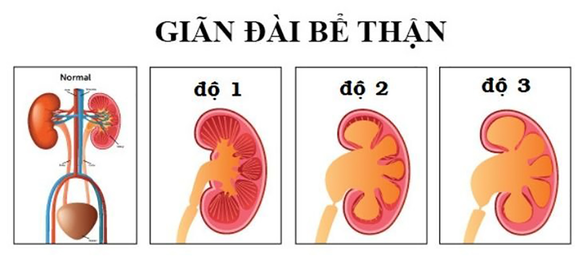 Giãn đài bể thận Giãn đài bể thận