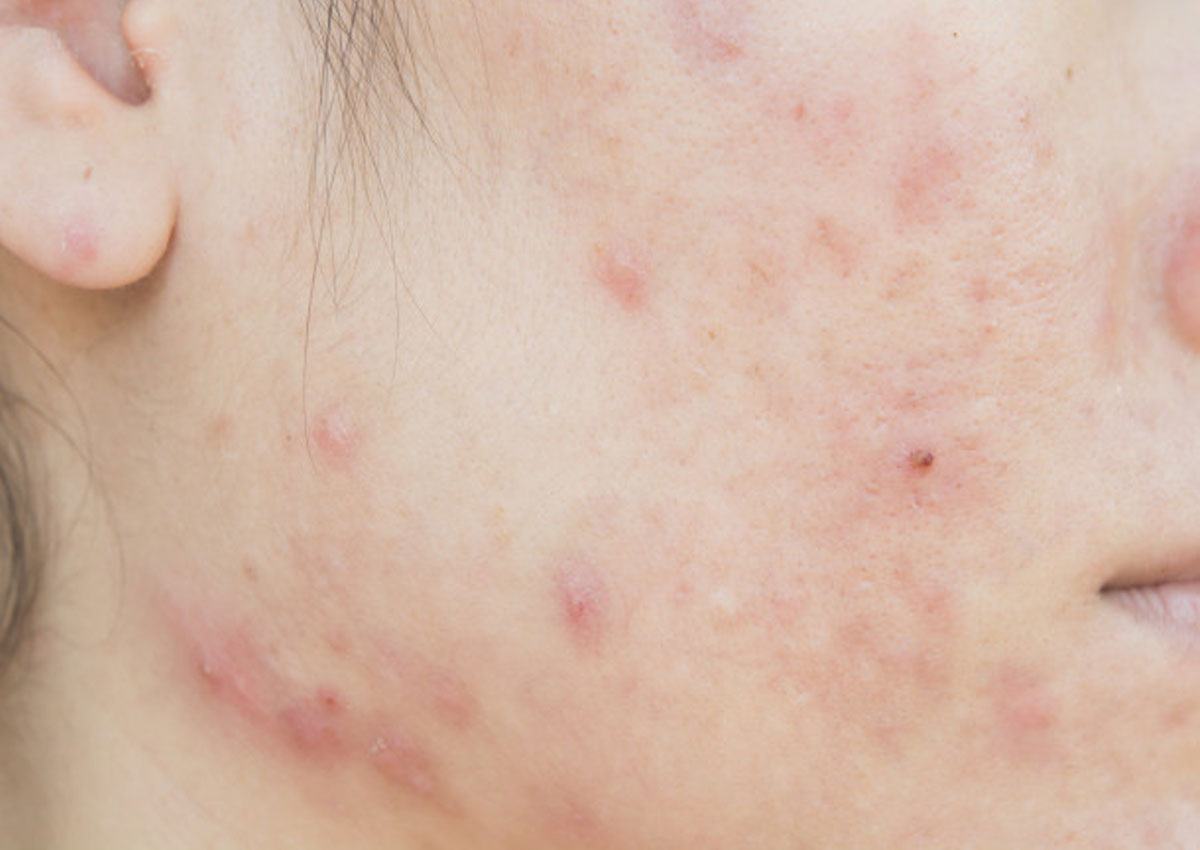 mụn tuổi dậy thì mụn tuổi dậy thì