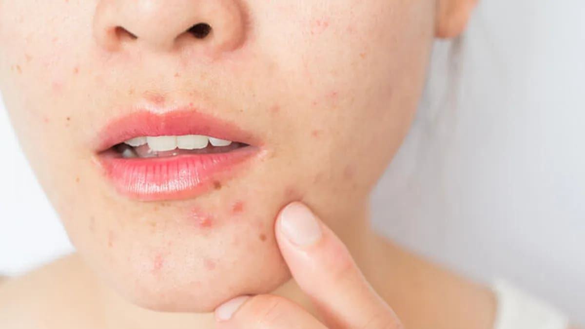 cách nặn mụn bọc ở cằm cách nặn mụn bọc ở cằm