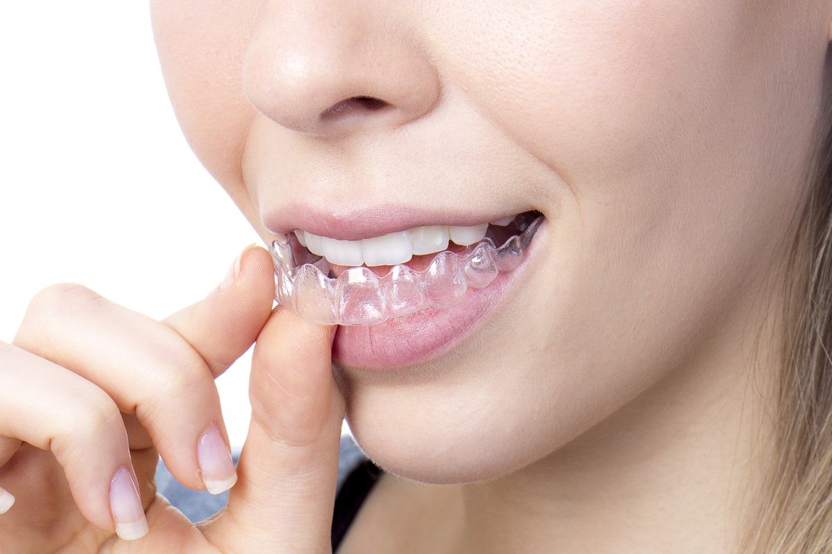 Nhược điểm niềng răng trong suốt Nhược điểm niềng răng trong suốt