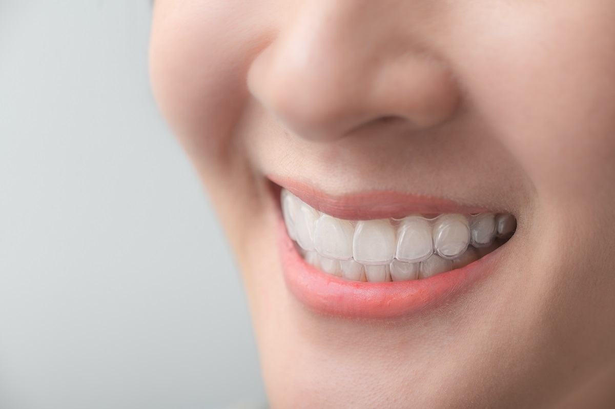 niềng răng trong suốt có mấy loại niềng răng trong suốt có mấy loại