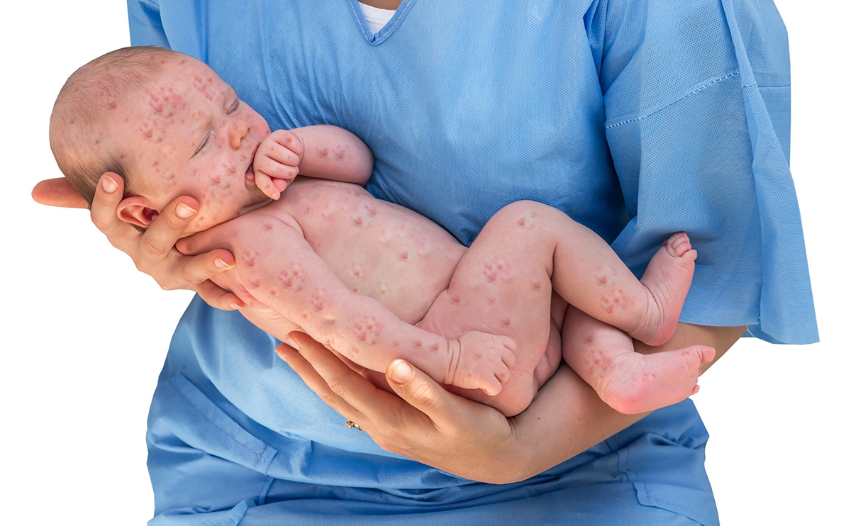 Hội chứng Rubella bẩm sinh nguy hiểm cho bé như thế nào? 34 Bệnh Rubella bẩm sinh ở trẻ là gì?