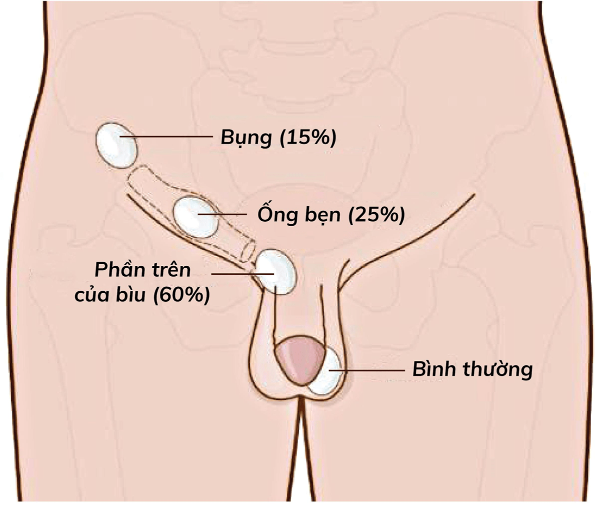 tinh hoàn ẩn là gì ? tinh hoàn ẩn là gì