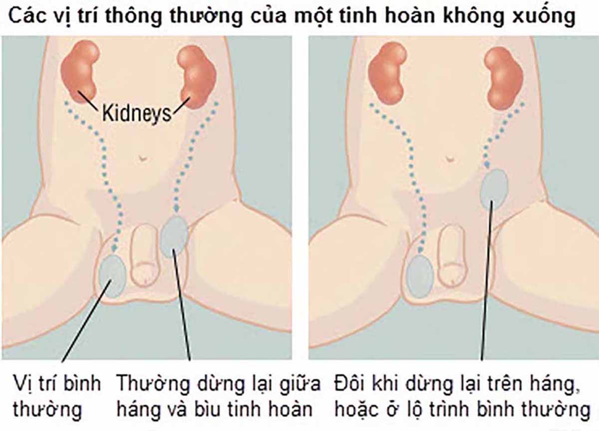 Tinh hoàn lạc chỗ là gì Tinh hoàn lạc chỗ là gì