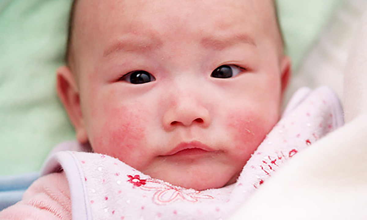 Trẻ bị dị ứng thời tiết có nguy hiểm không, ba mẹ nên làm gì? 3