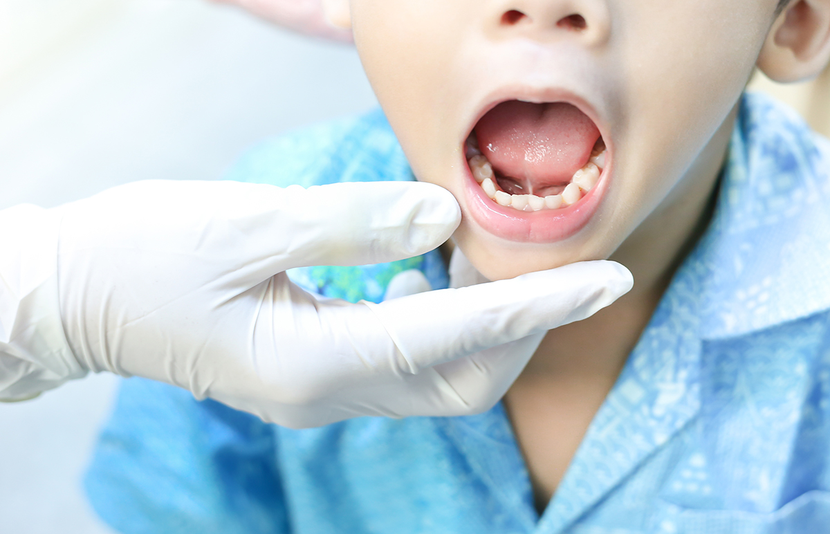 Dấu hiệu trẻ bị dính thắng lưỡi
