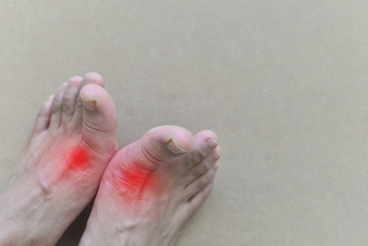 Điều trị bệnh Gout như thế nào Điều trị bệnh Gout như thế nào