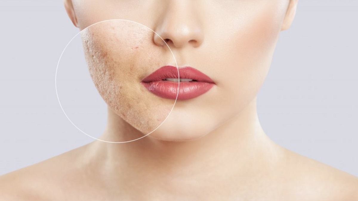 Cấy collagen tươi có tốt không Cấy collagen tươi có tốt không