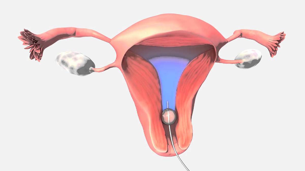 IUI là gì IUI và IVF là gì