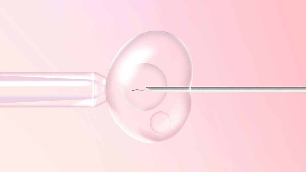 IUI và IVF khác nhau như thế nào IUI và IVF khác nhau như thế nào