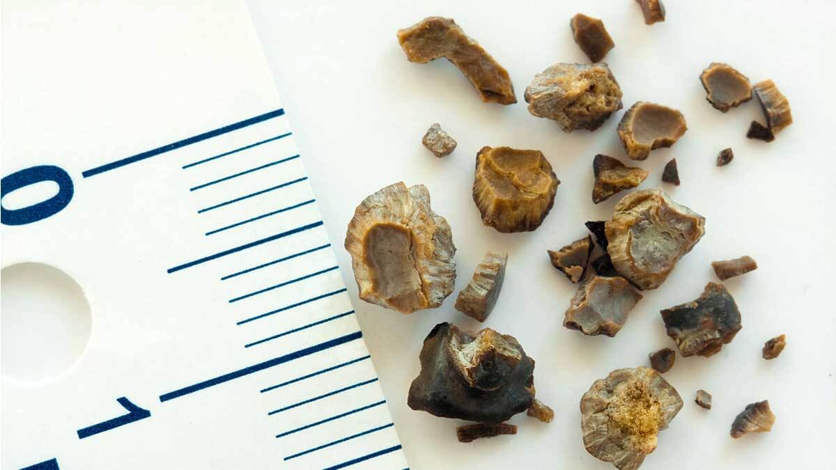 Sỏi thận là gì