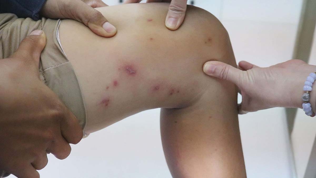 trẻ bị kiến ba khoang đốt