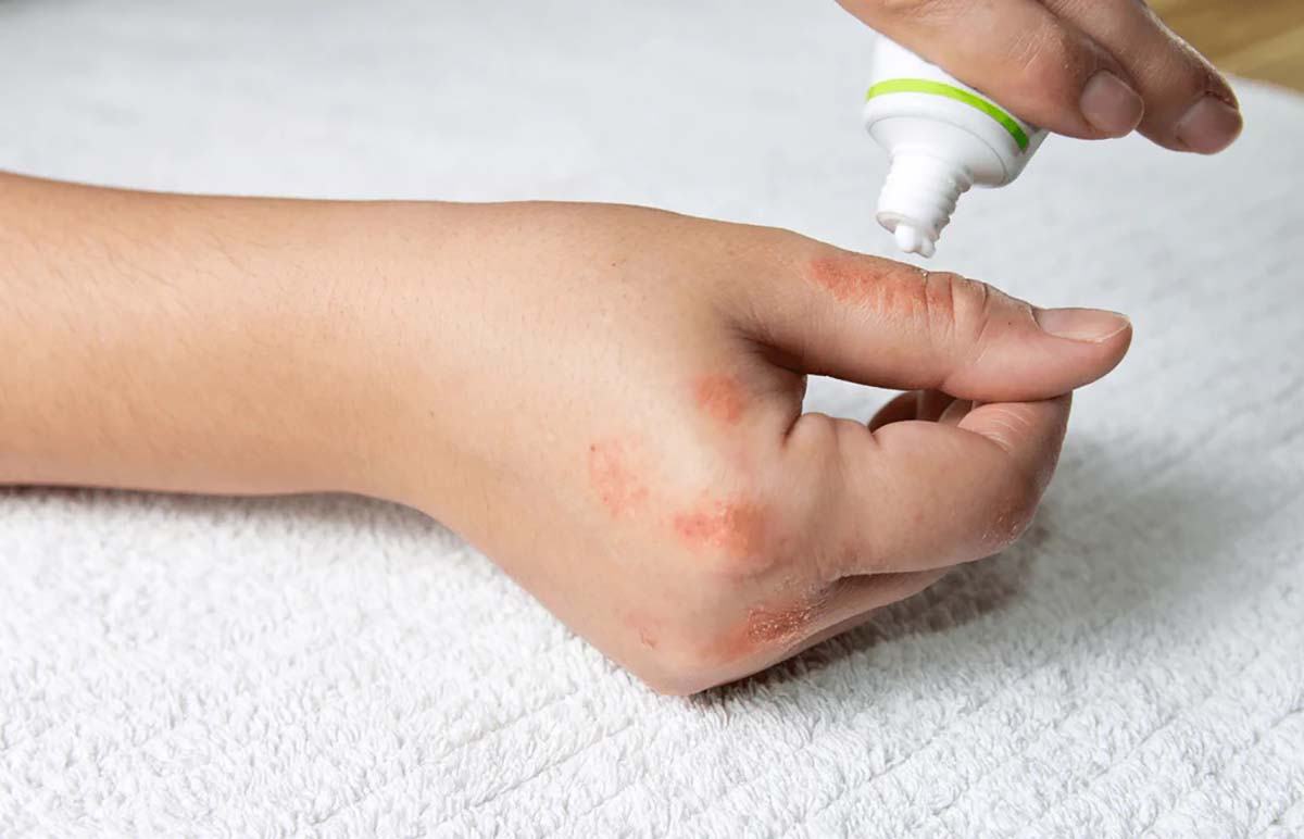 Thuốc bôi kiến ba khoang cho bé