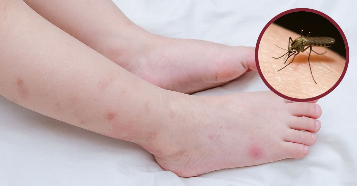 trẻ sơ sinh bị muỗi đốt