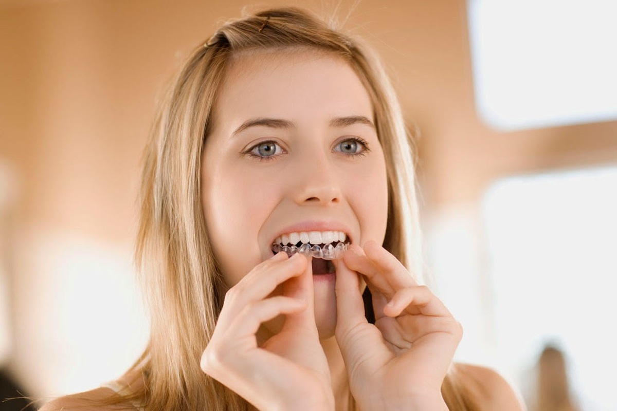 Sau khi niềng răng cần làm gì Sau khi niềng răng cần làm gì